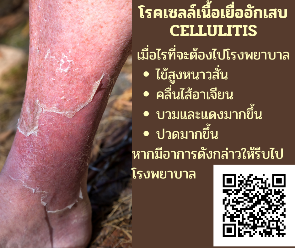 เซลล์เนื้อเยื่ออักเสบ cellulitis